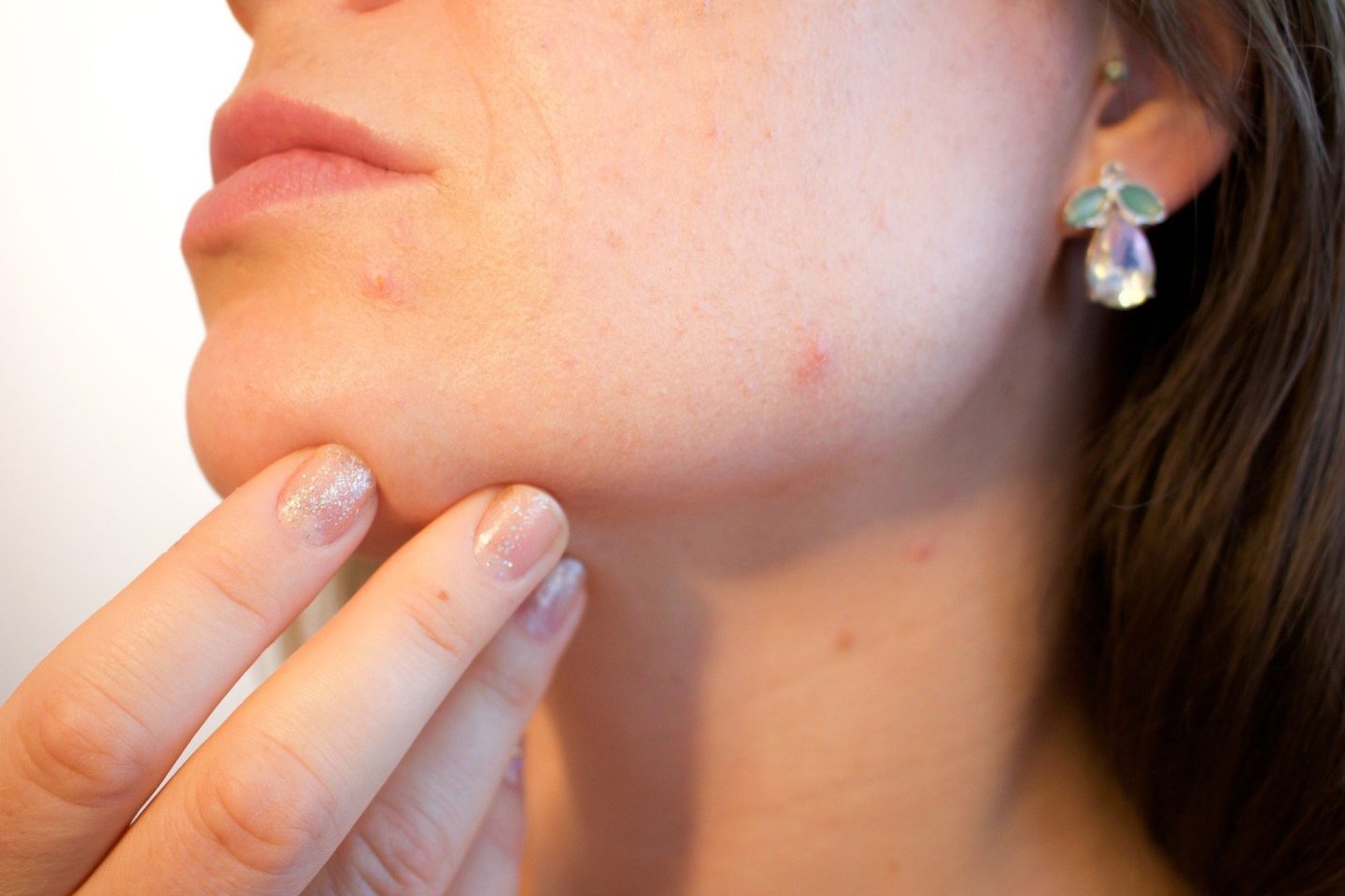 How to know if you have skin acne