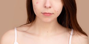 acne scar vs hyperpigmentation