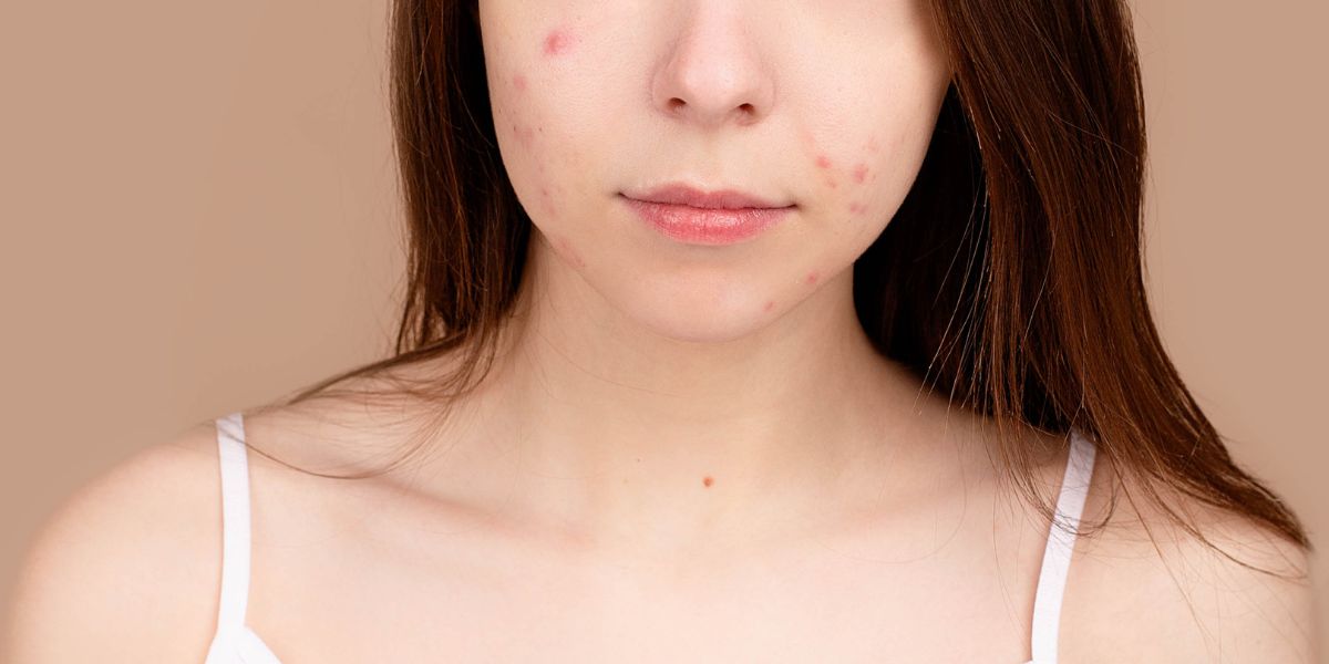 Acne Scar vs Hyperpigmentation: What’s the difference? 2 acne scar vs hyperpigmentation