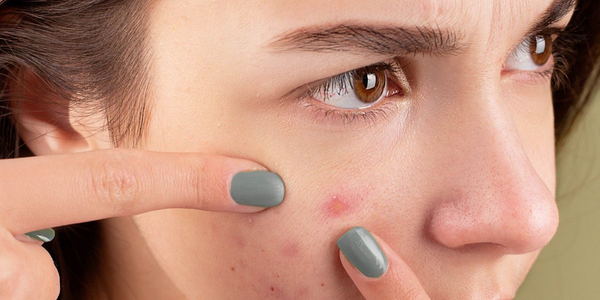 acne scar vs hyperpigmentation