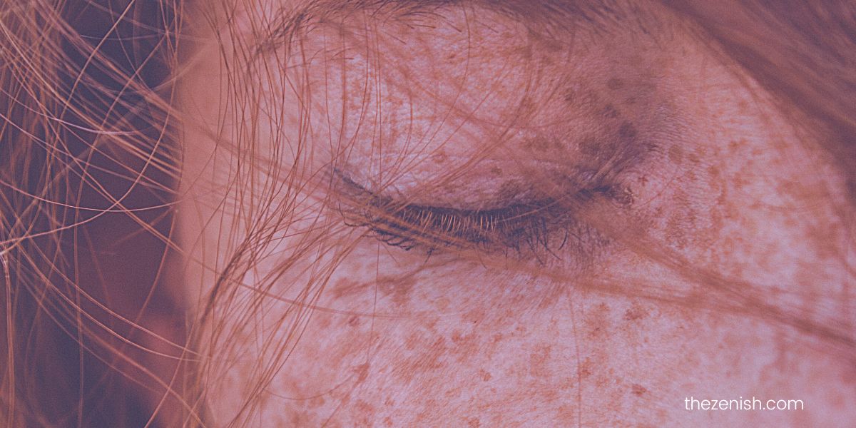 Hyperpigmentation vs Freckles